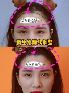 ​怎样调整发际线（调整发际线的方法）