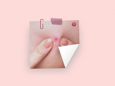 ​闭合性粉刺的前因后果以及解决办法都在这了