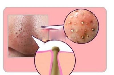 ​脸上的黑头会自己消失吗(小气泡去黑头多久一次比较好)