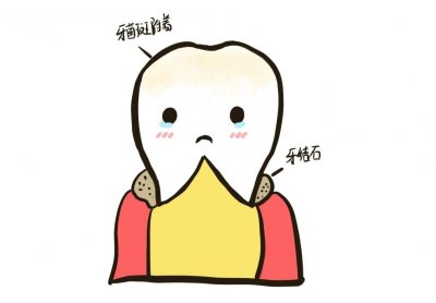​不知不觉中，牙结石已经开始掏空你的牙齿了